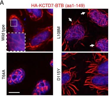 Published Figure 4A showing immunofluorescence microscopy of HA-tagged KCTD7-BTB wild type and T64A, L108M, and D115Y patient variants in Kyoto HeLa cells; KCTD7 is red and nuclei are blue.